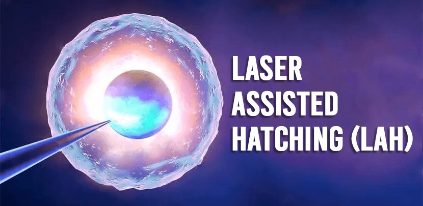 Laser-Assisted Hatching (LAH) Treatment in IVF